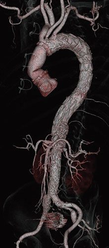 “「ステントグラフト治療を用いた大動脈形成術」実施後の大動脈