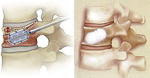 経皮的椎体形成術