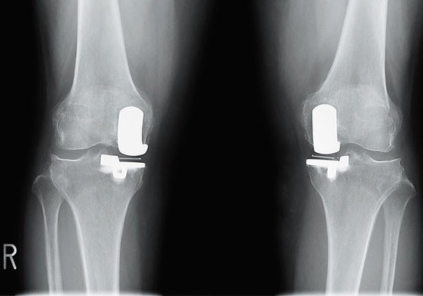 負担の少ない部分人工関節を使用し両膝同時に手術を行う