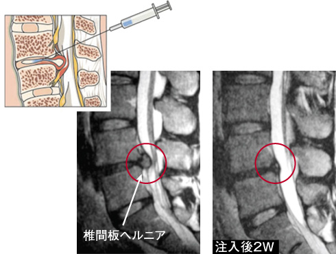 ●コンドリアーゼを用いた椎間板髄核融解術　短期間に軟骨終板を傷めずにヘルニアを縮小させることが可能