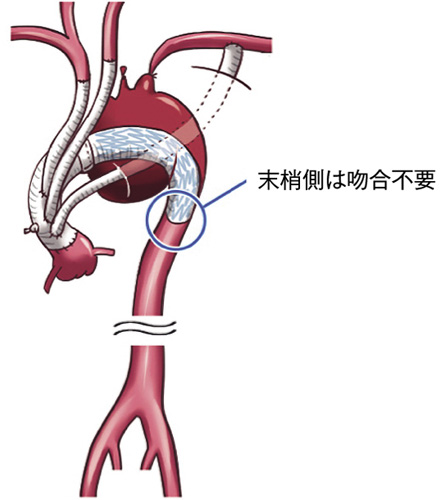 人工血管置換術とオープンステント術