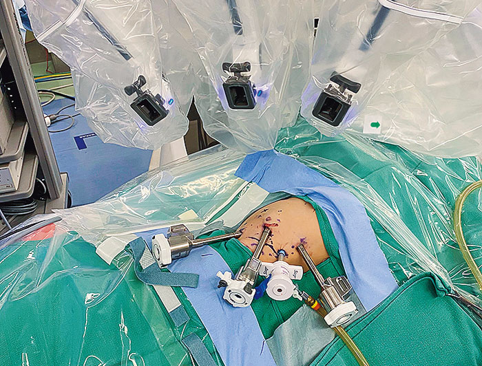 小児に於けるロボット支援手術：胆道拡張症根治術、腎盂（じんう）形成、縦隔腫瘍切除が保険適用となった。