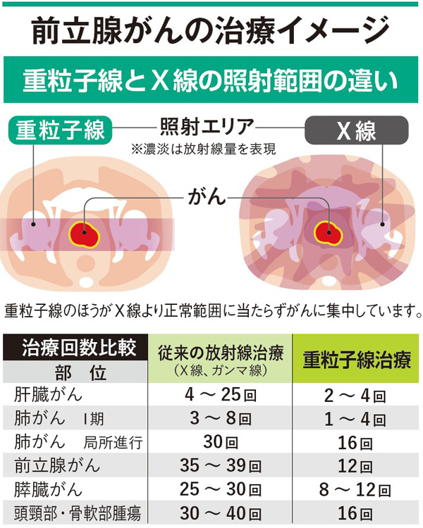 前立腺がんの治療イメージ