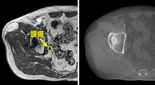 右がCT画像。がんの輪郭がはっきりしない。MRI(左)では筋肉や血管などがはっきり映し出される