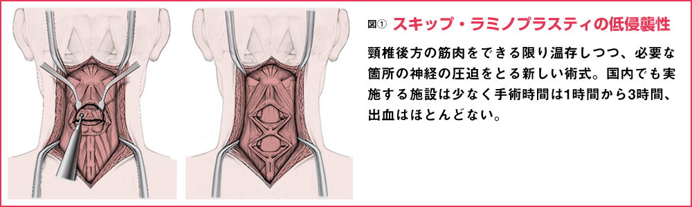 スキップ・ラミノプラスティの低侵襲性