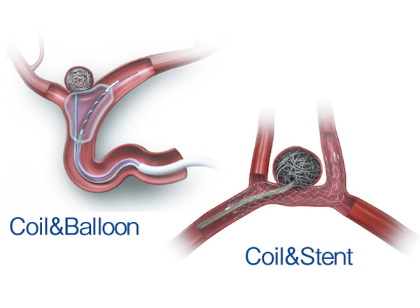 「コイル塞栓術」脳動脈瘤内に医療用の金属の糸（コイル）を数本入れ、血液が流れ込まないように塞ぐ