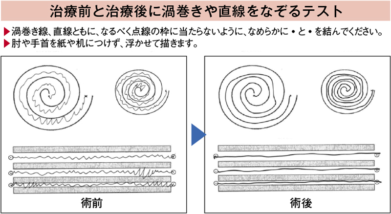 治療前と治療後に渦巻きや直線をなぞるテスト