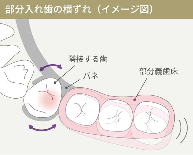 部分入れ歯の横ずれ（イメージ図）