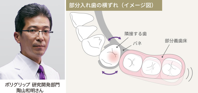 部分入れ歯の横ずれ（イメージ図）