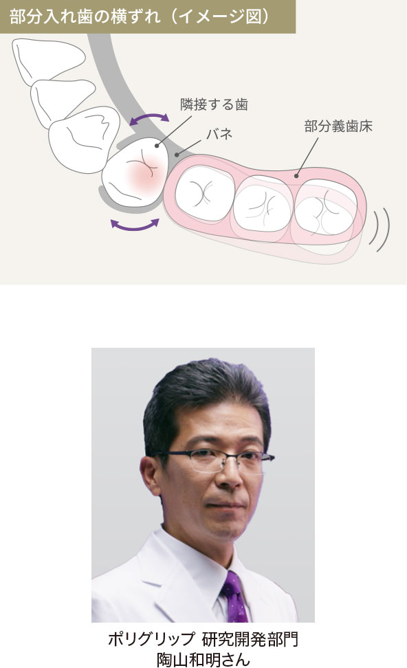 部分入れ歯の横ずれ（イメージ図）