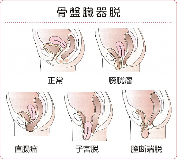 骨盤臓器脱