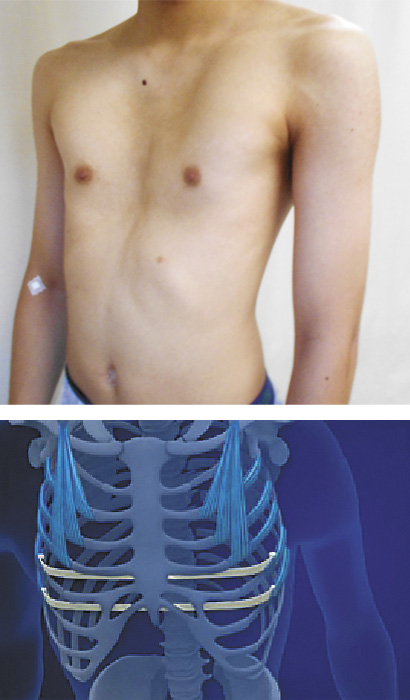 上：漏斗胸18歳男性グレードⅡ術前　下：手術は肋骨にプレートを固定し前胸部陥凹を矯正