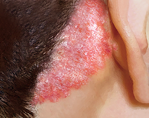 何が乾癬の再燃を引き起こすのでしょうか?